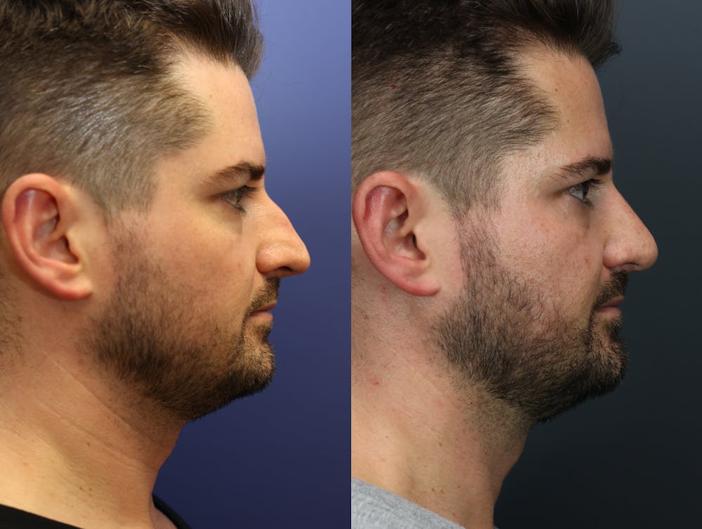 Rhinoplasty (Nose Reshaping) Before & After Gallery - Patient 365233 - Image 5