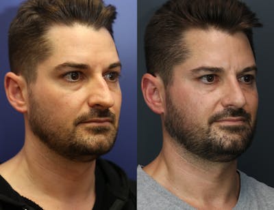 Rhinoplasty (Nose Reshaping) Before & After Gallery - Patient 365233 - Image 4