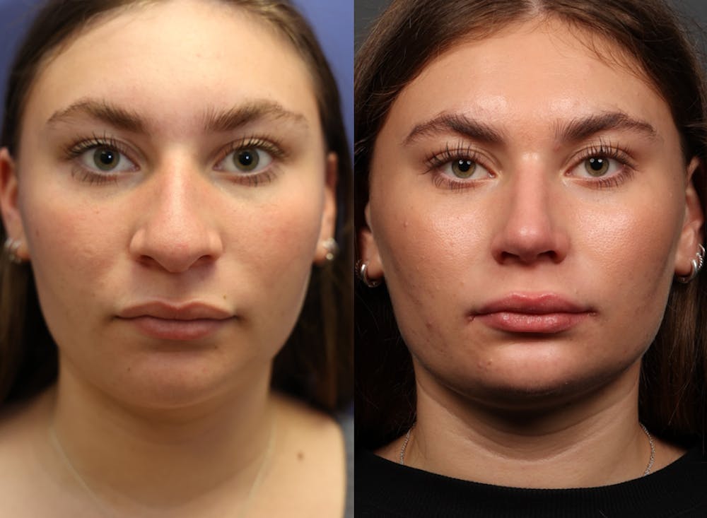 Rhinoplasty (Nose Reshaping) Before & After Gallery - Patient 197485 - Image 3