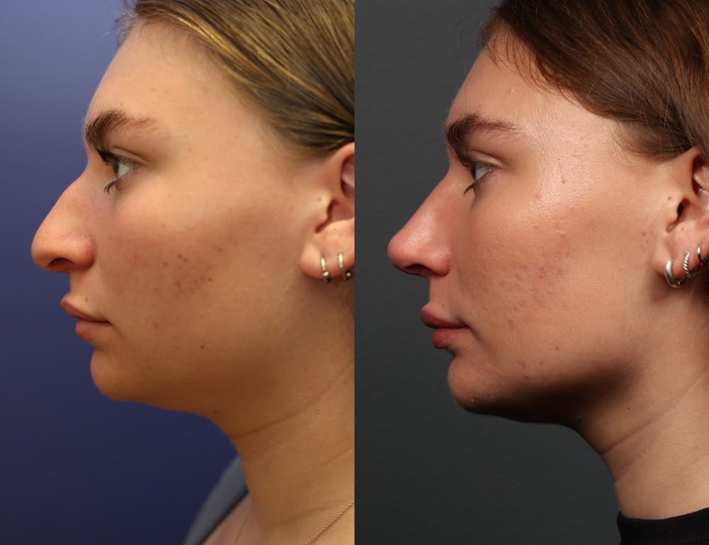 Rhinoplasty (Nose Reshaping) Before & After Gallery - Patient 197485 - Image 4