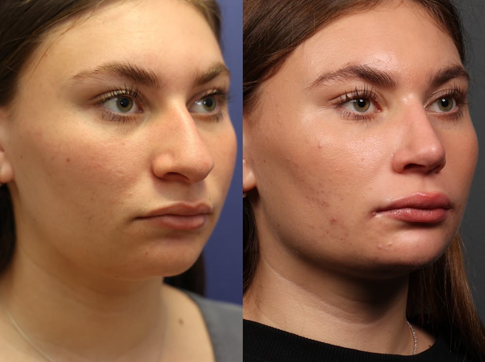 Rhinoplasty (Nose Reshaping) Before & After Gallery - Patient 197485 - Image 2