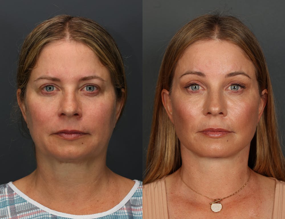 Deep Plane Facelift Before & After Gallery - Patient 123517 - Image 1