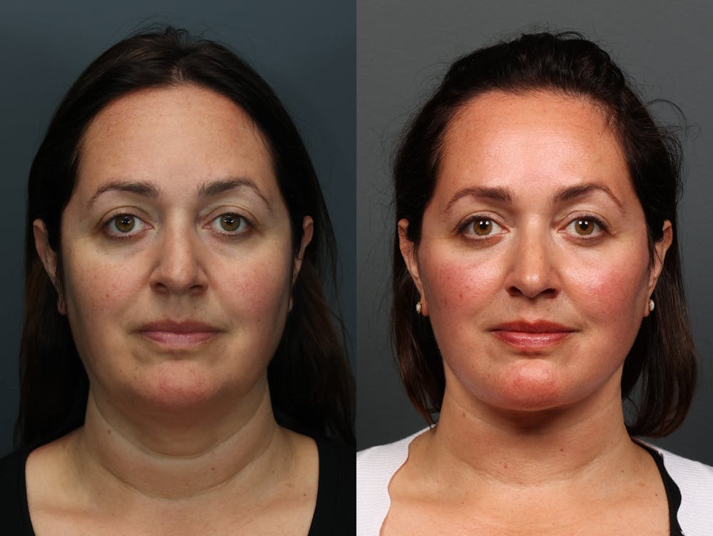 Eyelid Surgery Before & After Gallery - Patient 355035 - Image 3