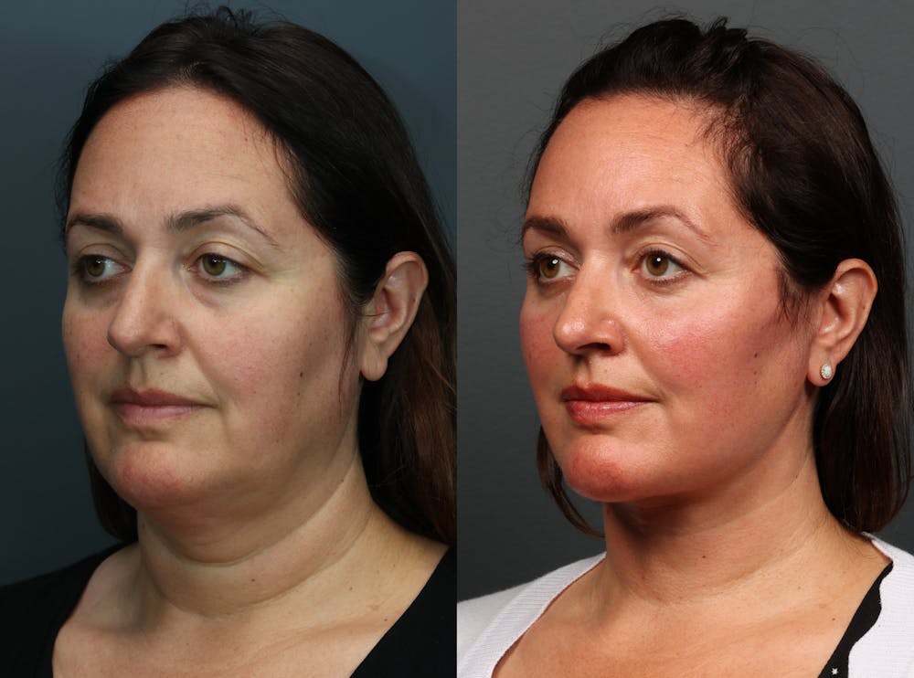 Eyelid Surgery Before & After Gallery - Patient 355035 - Image 2