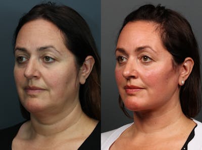 Eyelid Surgery Before & After Gallery - Patient 355035 - Image 2