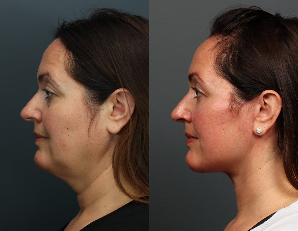 Eyelid Surgery Before & After Gallery - Patient 355035 - Image 1