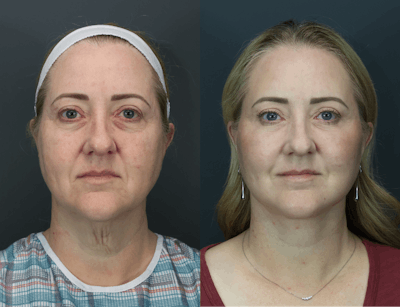 Eyelid Surgery Before & After Gallery - Patient 139485 - Image 1