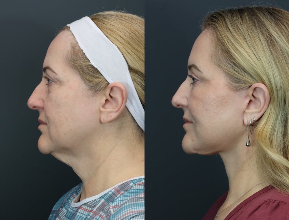 Eyelid Surgery Before & After Gallery - Patient 139485 - Image 3