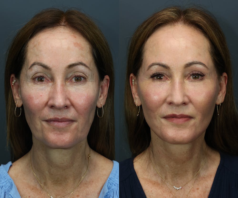 Eyelid Surgery Before & After Gallery - Patient 427102 - Image 1