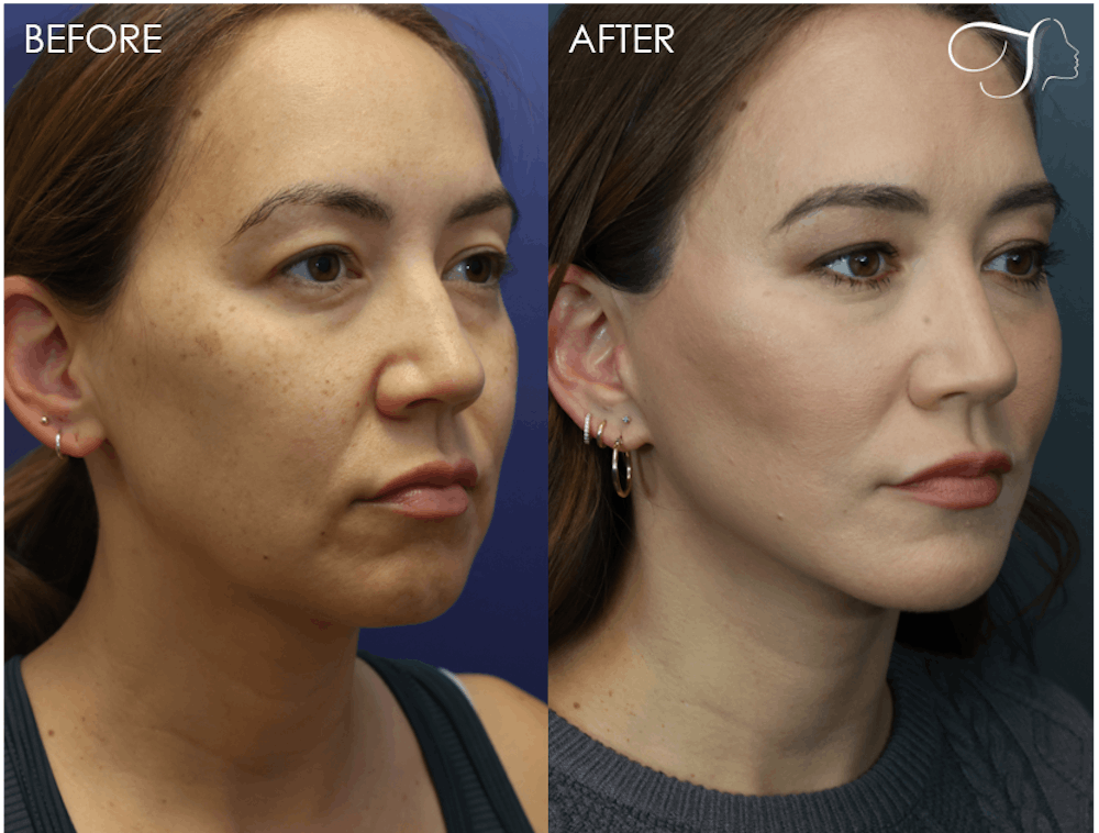Deep Plane Facelift Before & After Gallery - Patient 240781 - Image 2