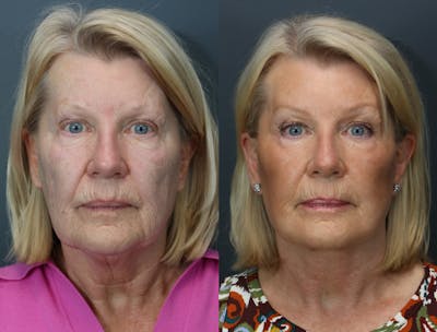 Deep Plane Neck Lift Before & After Gallery - Patient 219713 - Image 2