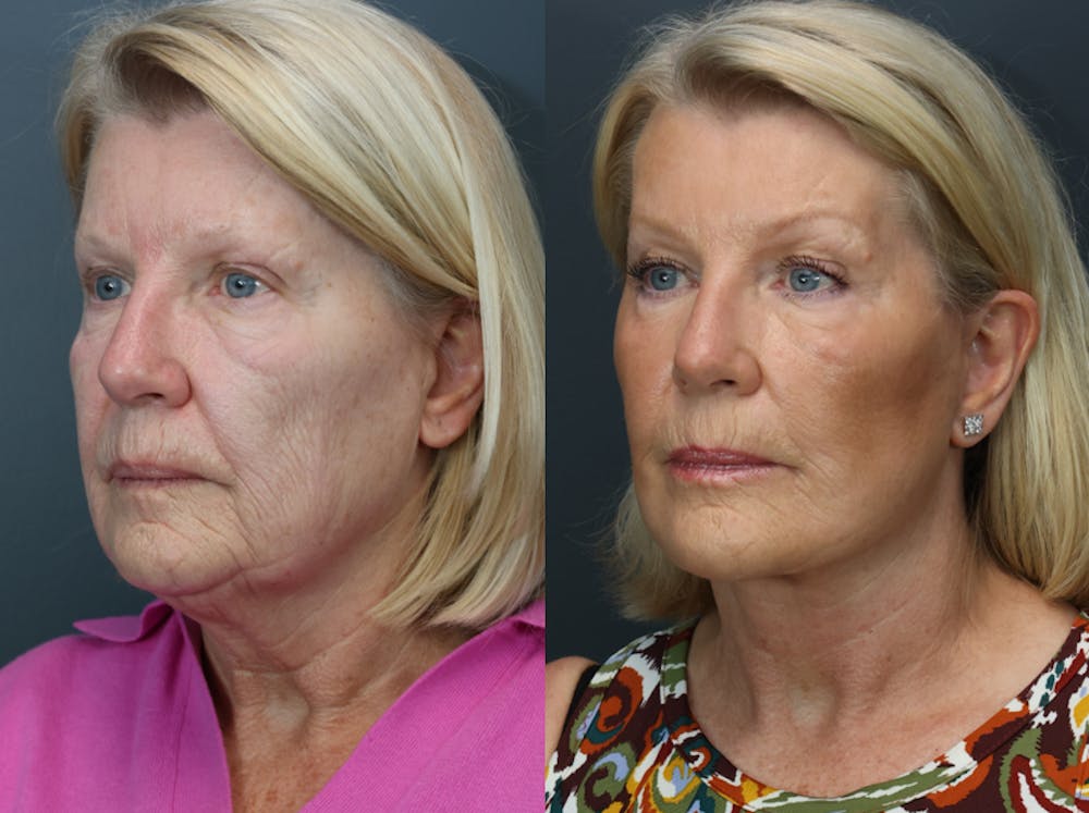 Deep Plane Neck Lift Before & After Gallery - Patient 219713 - Image 3