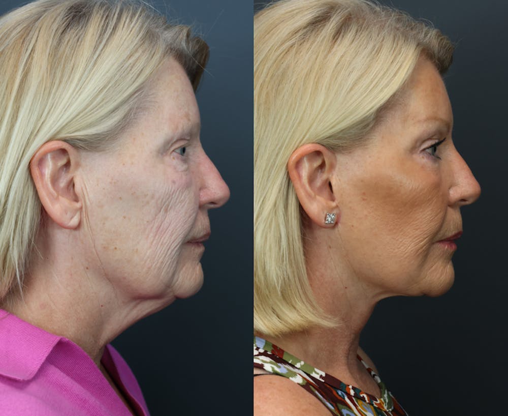 Deep Plane Neck Lift Before & After Gallery - Patient 219713 - Image 1