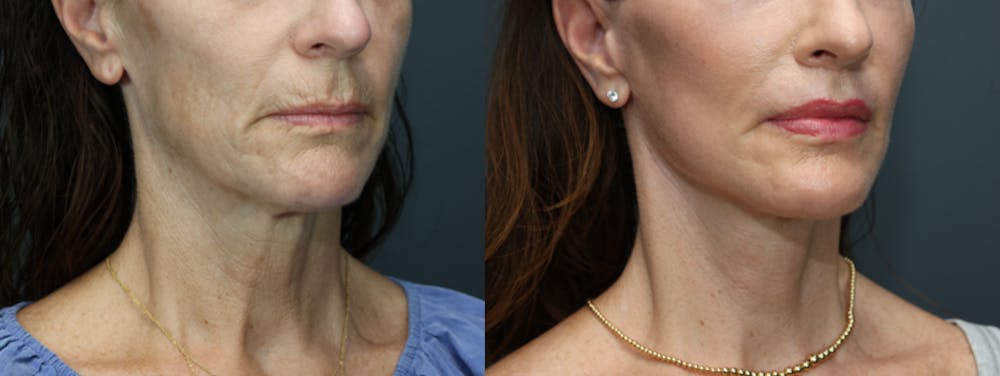 Deep Plane Neck Lift Before & After Gallery - Patient 992328 - Image 1