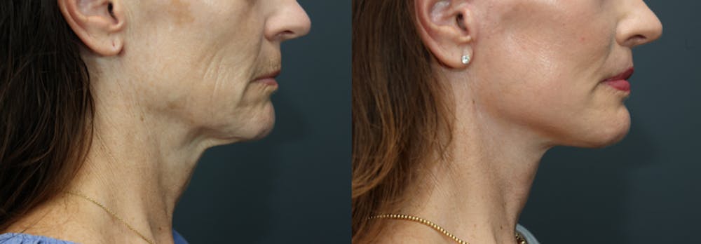 Deep Plane Neck Lift Before & After Gallery - Patient 992328 - Image 3