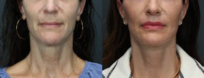 Deep Plane Neck Lift Before & After Gallery - Patient 992328 - Image 2