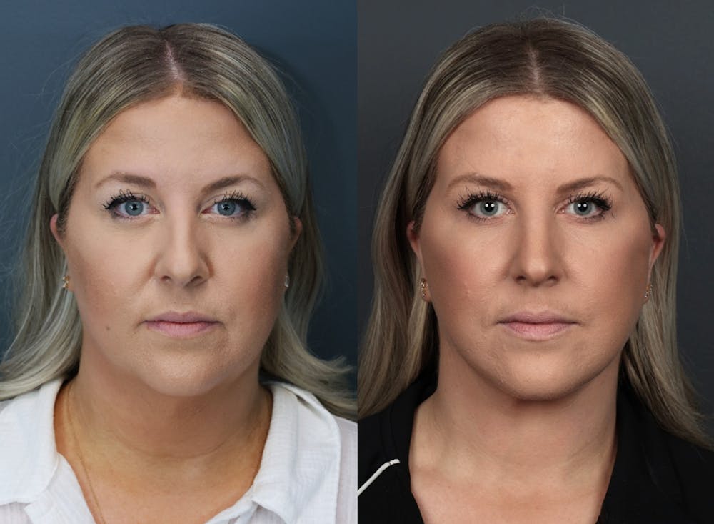Deep Plane Facelift Before & After Gallery - Patient 332593 - Image 5