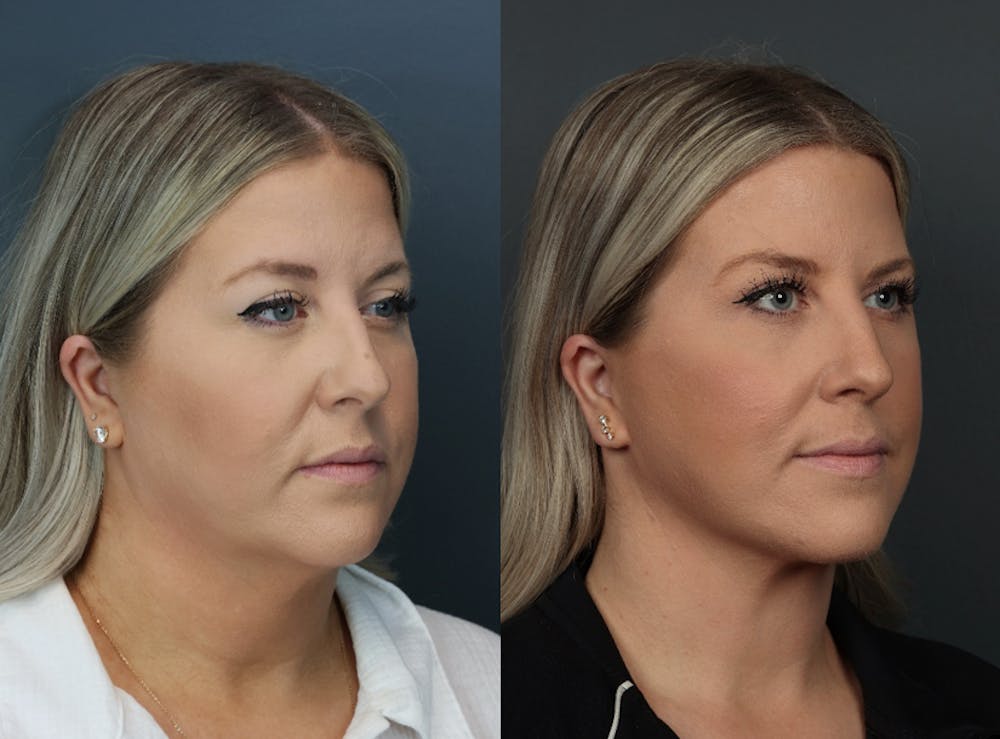 Deep Plane Facelift Before & After Gallery - Patient 332593 - Image 3