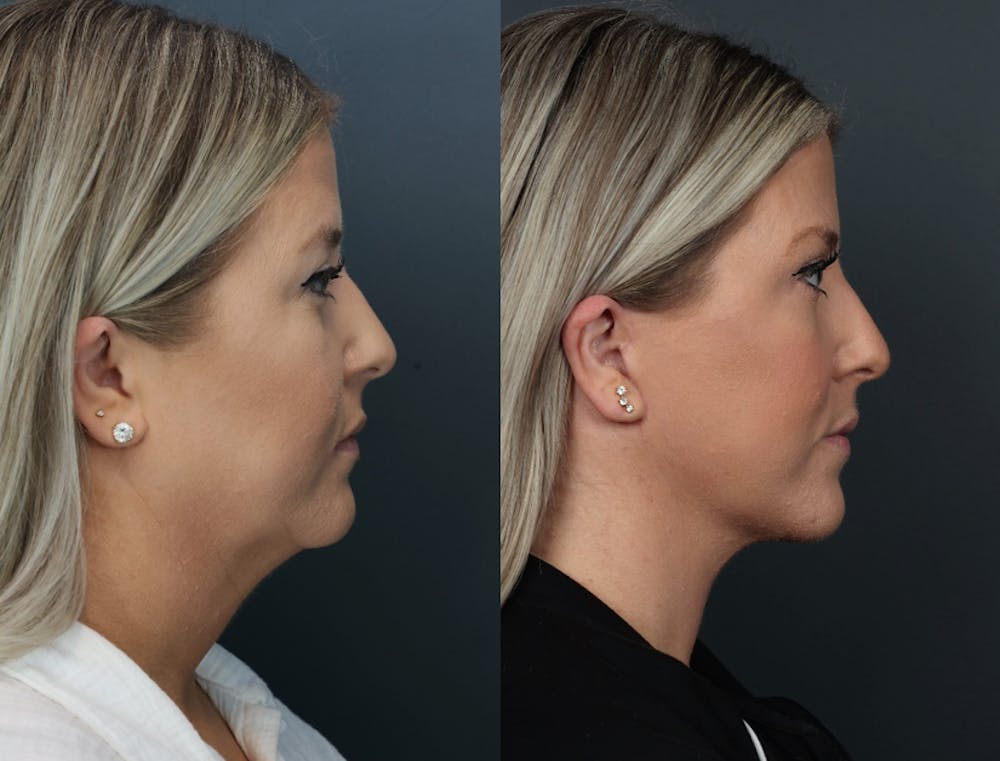 Deep Plane Facelift Before & After Gallery - Patient 332593 - Image 1