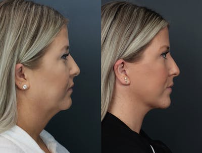 Deep Plane Facelift Before & After Gallery - Patient 332593 - Image 1
