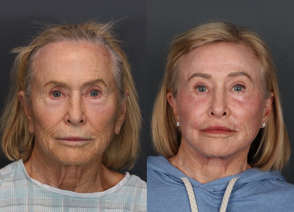 Facial Revolumizing (Fat Transfer) Before & After Gallery - Patient 268113 - Image 1
