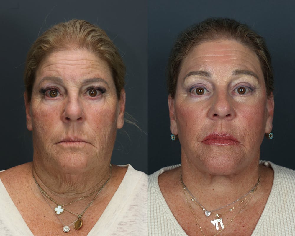 Deep Plane Facelift Before & After Gallery - Patient 628993 - Image 3