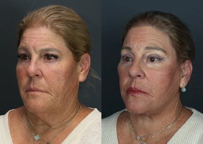 Deep Plane Facelift Before & After Gallery - Patient 628993 - Image 1