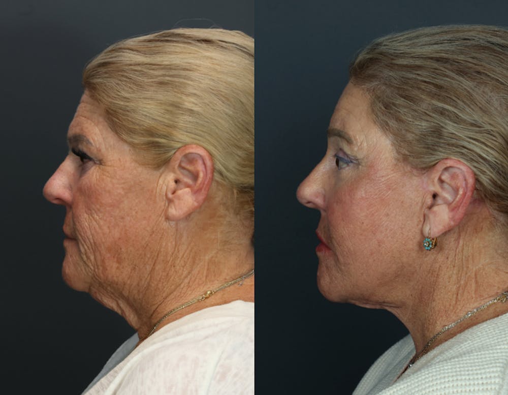 Deep Plane Facelift Before & After Gallery - Patient 628993 - Image 2