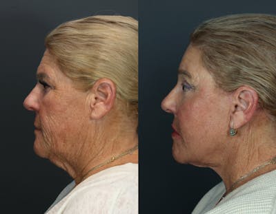 Deep Plane Facelift Before & After Gallery - Patient 628993 - Image 2