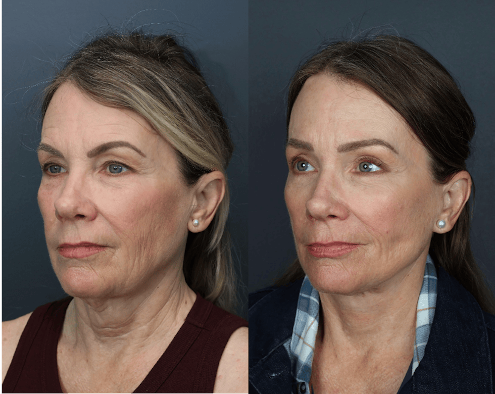 Deep Plane Neck Lift Before & After Gallery - Patient 201923 - Image 1