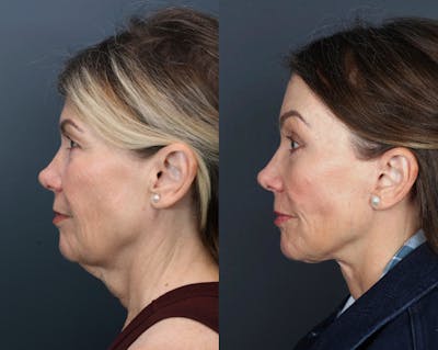 Deep Plane Neck Lift Before & After Gallery - Patient 201923 - Image 2