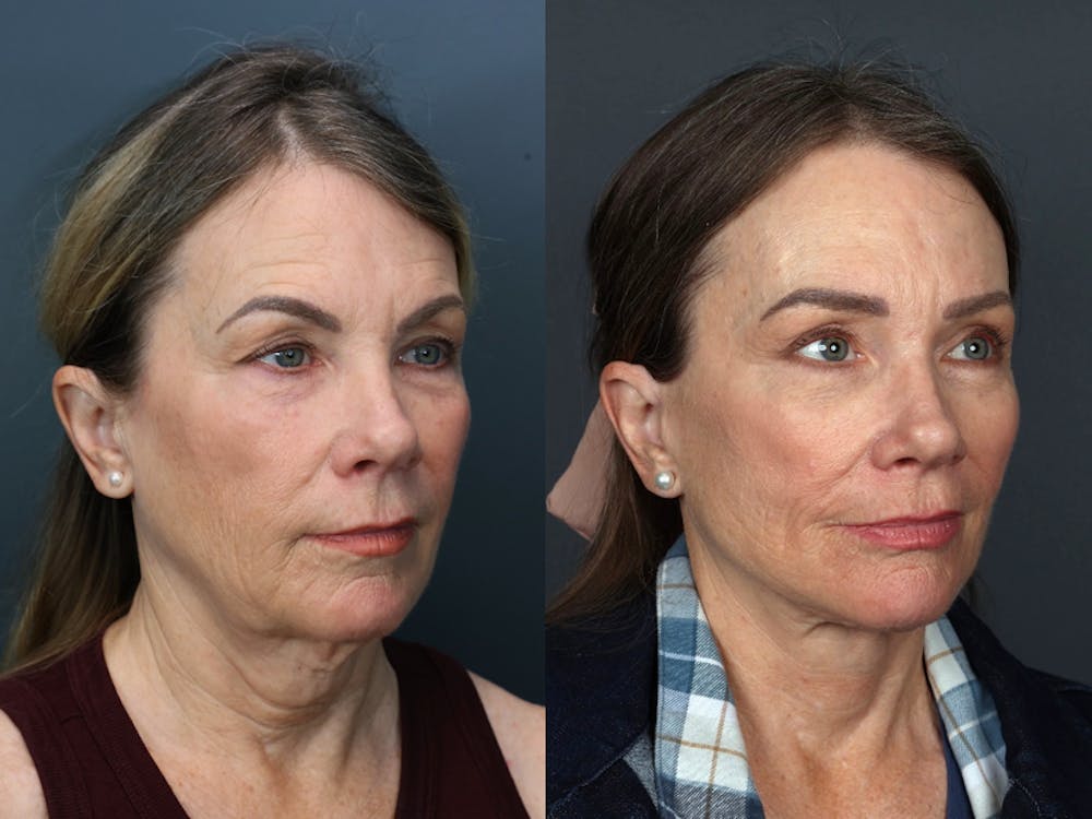 Deep Plane Neck Lift Before & After Gallery - Patient 201923 - Image 3