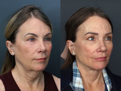 Deep Plane Facelift Before & After Gallery - Patient 112016 - Image 2