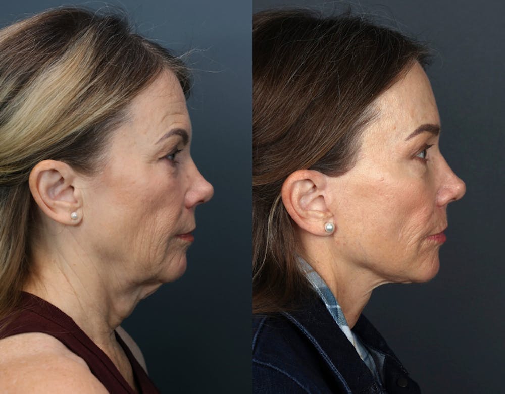 Deep Plane Neck Lift Before & After Gallery - Patient 201923 - Image 4