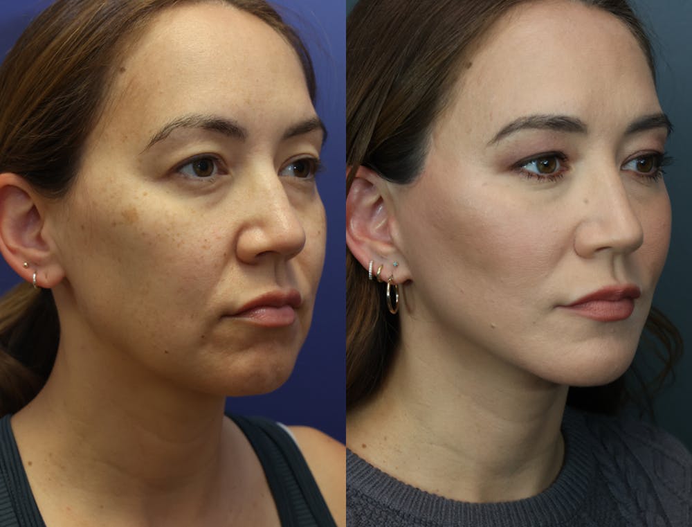 Deep Plane Facelift Before & After Gallery - Patient 240781 - Image 2