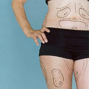 woman with surgical markings