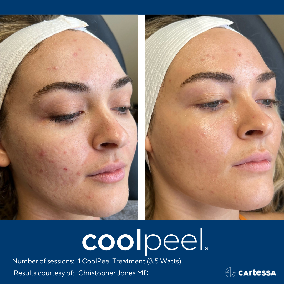 CoolPeel before and after pics