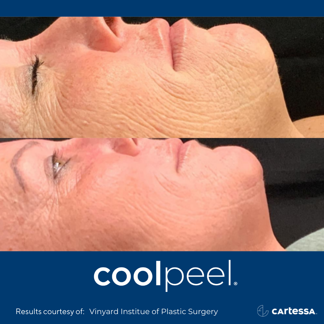 coolpeel before and after images