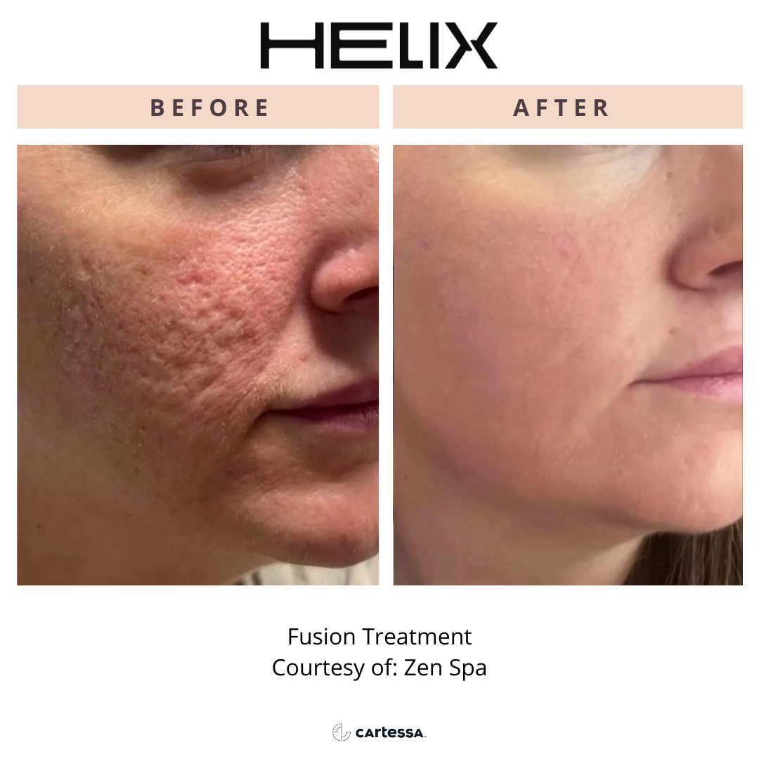 HELIX before and after images