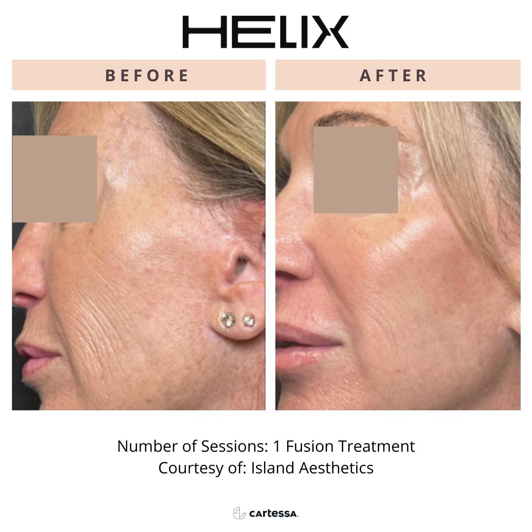 HELIX before and after images