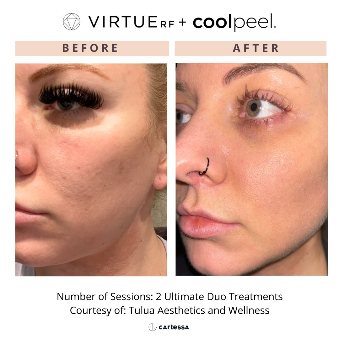 VirtueRF+ CoolPeel before and after images