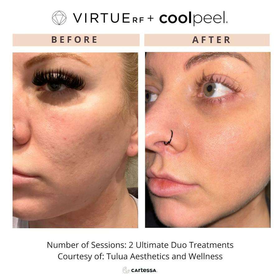 VirtueRF before and after images