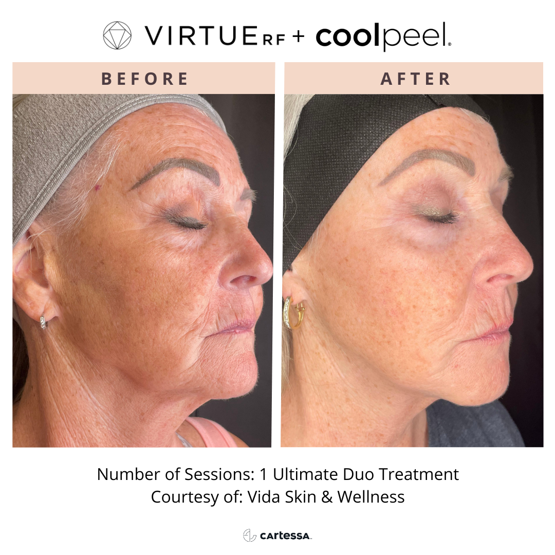 VirtueRF+ CoolPeel before and after images