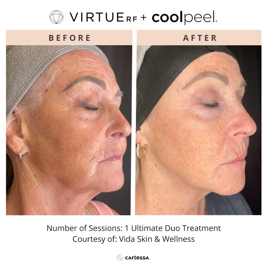 VirtueRF before and after images