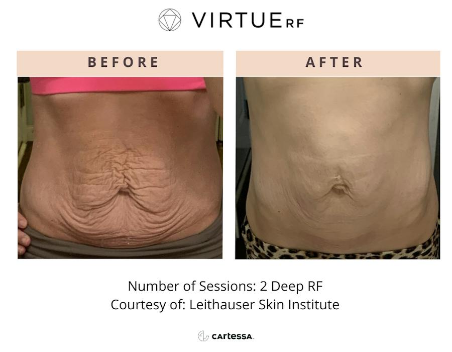 VirtueRF before and after images
