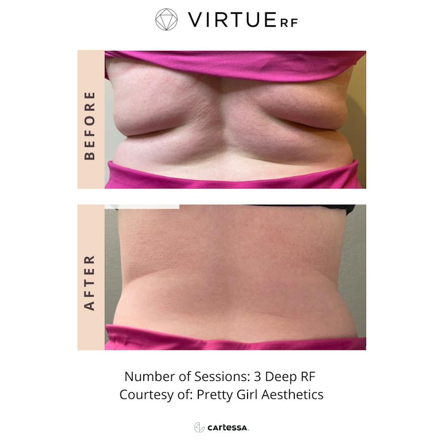 VirtueRF before and after images