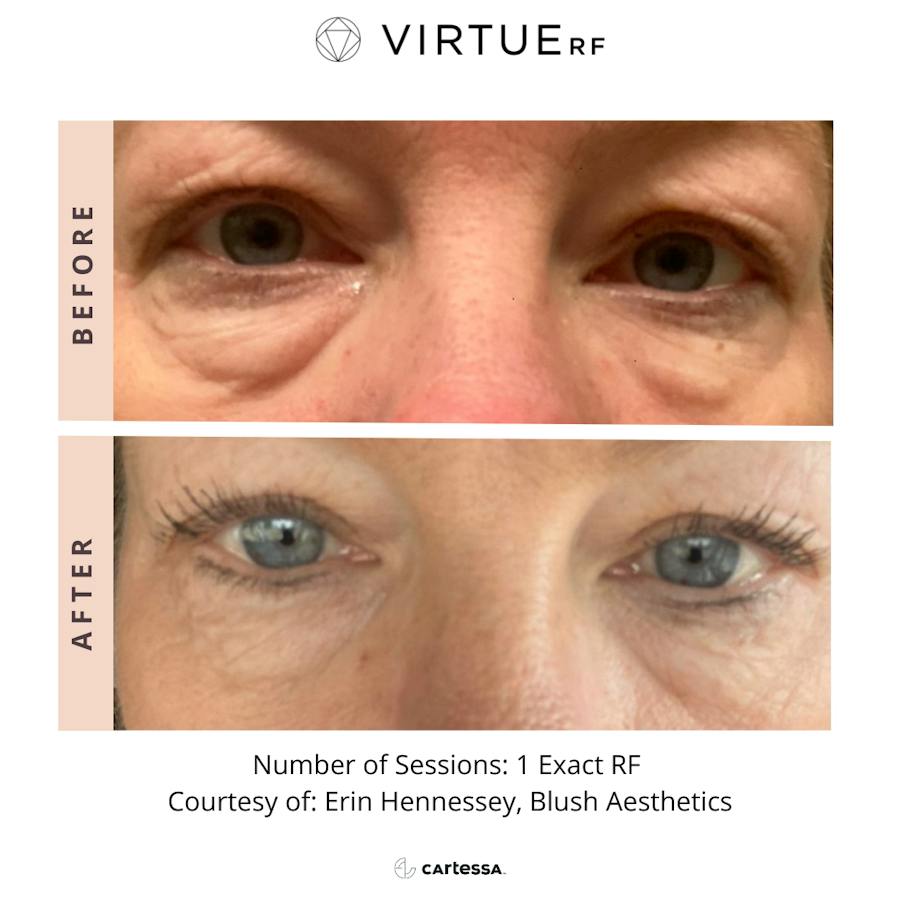 VirtueRF before and after images
