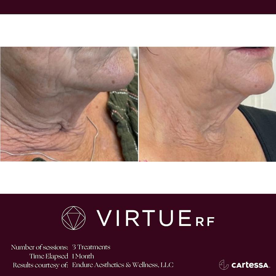 VirtueRF before and after images