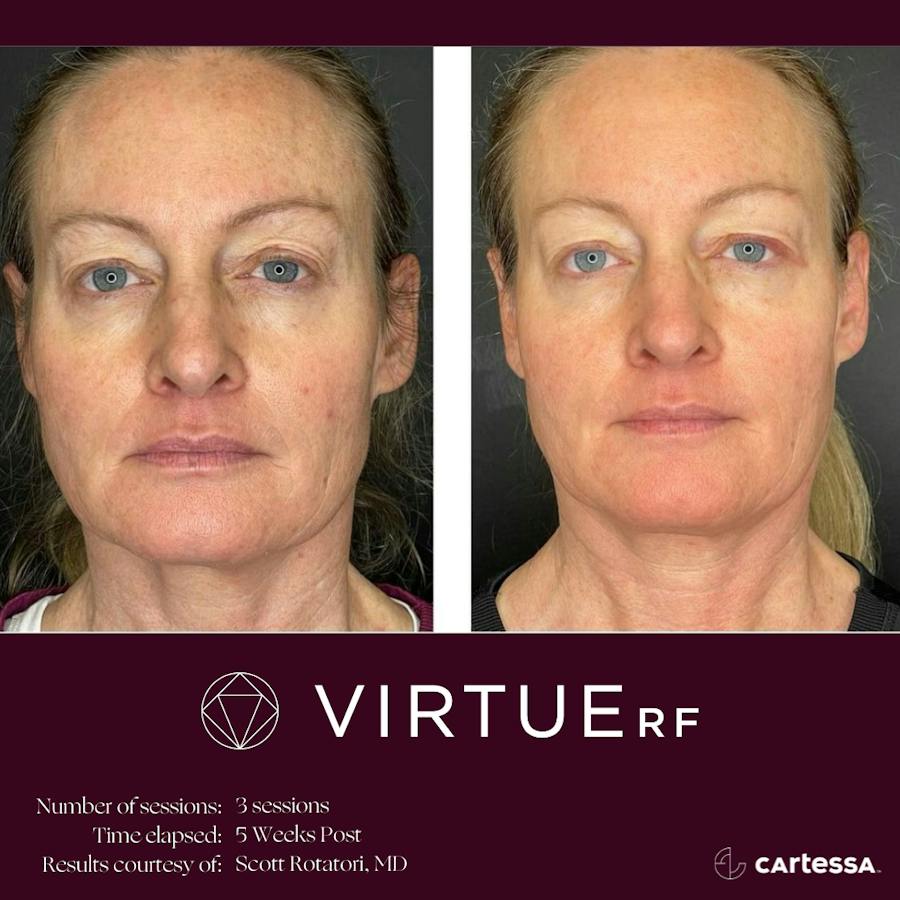 VirtueRF before and after images