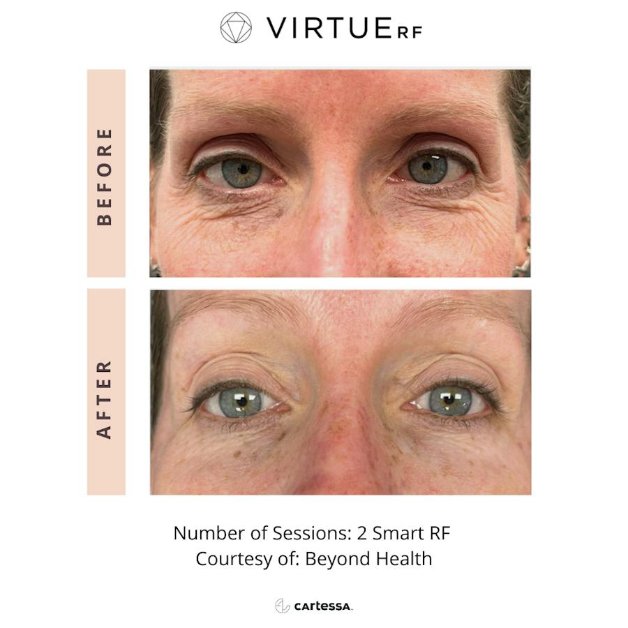 VirtueRF before and after images